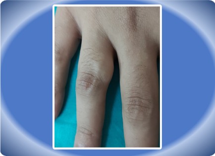 FINGER TUMOUR